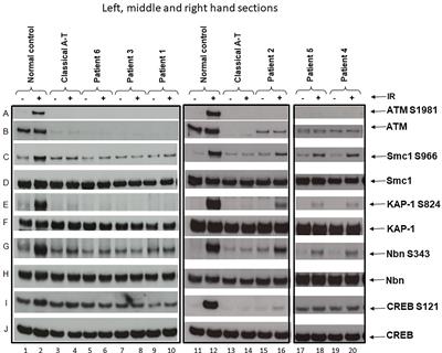 Childhood-Onset Movement Disorders Can Mask a Primary Immunodeficiency: 6 Cases of Classical Ataxia-Telangiectasia and <mark class="highlighted">Variant Forms</mark>